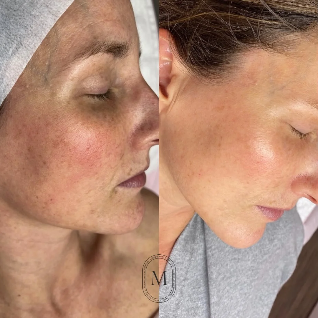 Progress check on our gorgeous client ✨ She came to us looking to target fine lines, pigmentation, sun spots and those stubborn capillaries.

We curated a custom treatment plan including a series of IPL sessions and microneedling &mdash; paired with 