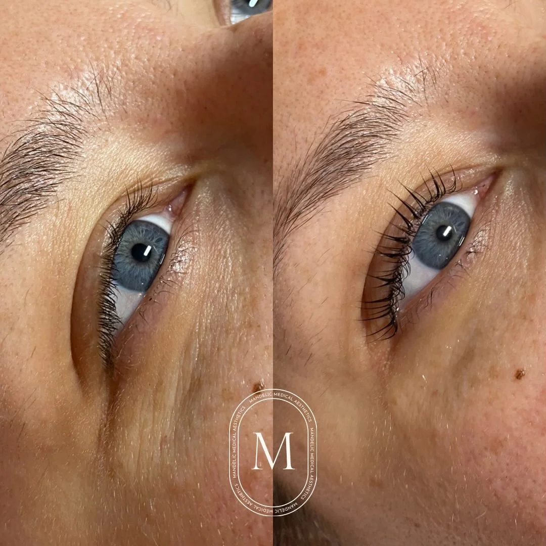 before &amp; after 💫

#mandelicmedicalaesthetics #waterfordontario #norfolkcountyontario #lashes #lashlift #lashliftandtint #naturallashes #beforeandafter