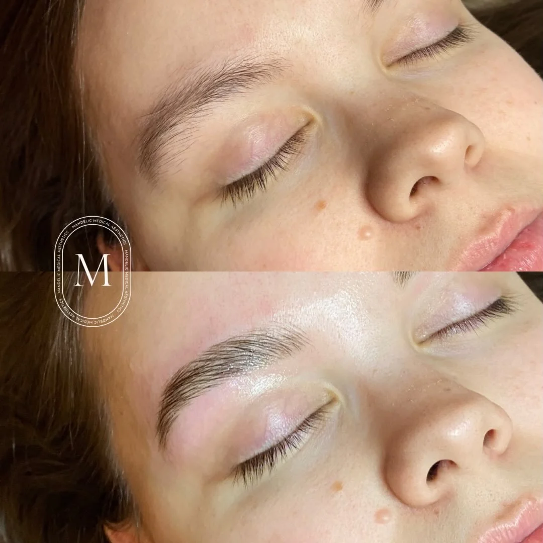 brow transformation by @edensaesthetics 

#mandelicmedicalaesthetics #waterfordontario #norfolkcountyontario #browtransformation #browlamination