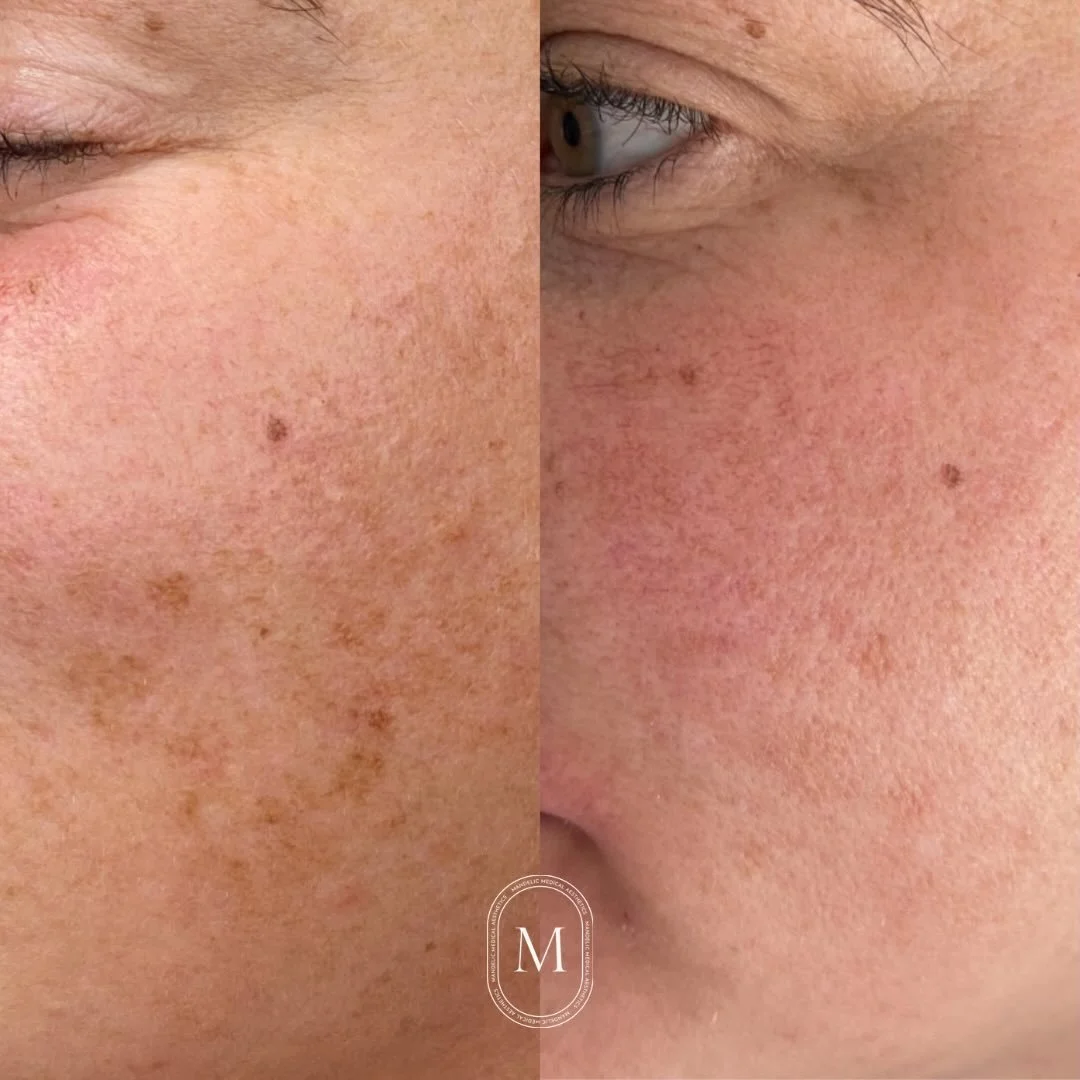 Before &amp; after 👏🏼

This glow-up is from only 𝗢𝗡𝗘 photo facial. 

Sun damage, pigmentation, redness, rosacea, broken capillaries, acne scarring, loss of elasticity, fine lines&mdash; 𝙝𝙖𝙣𝙙𝙡𝙚𝙙. 

With 5 advanced laser attachments and mul