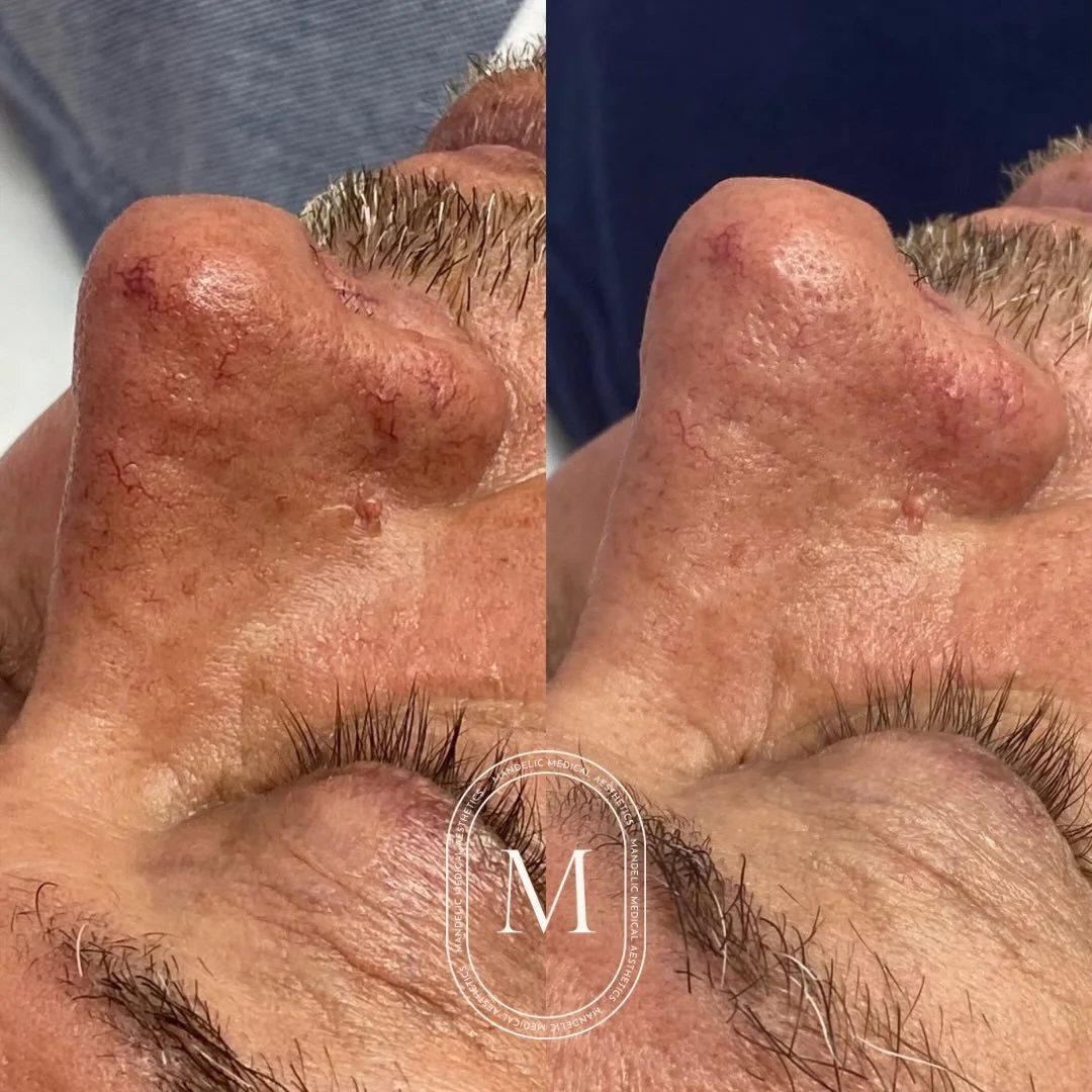 Broken capillaries? Consider them cancelled ⚡️

Our NEW Dual VP handpiece is smaller, more precise, and built to target:
✨ pigmentation
✨ PIE + PIH
✨ broken capillaries
✨ redness
✨ sun damage

From face &rarr; neck &rarr; chest &rarr; hands&hellip;sh
