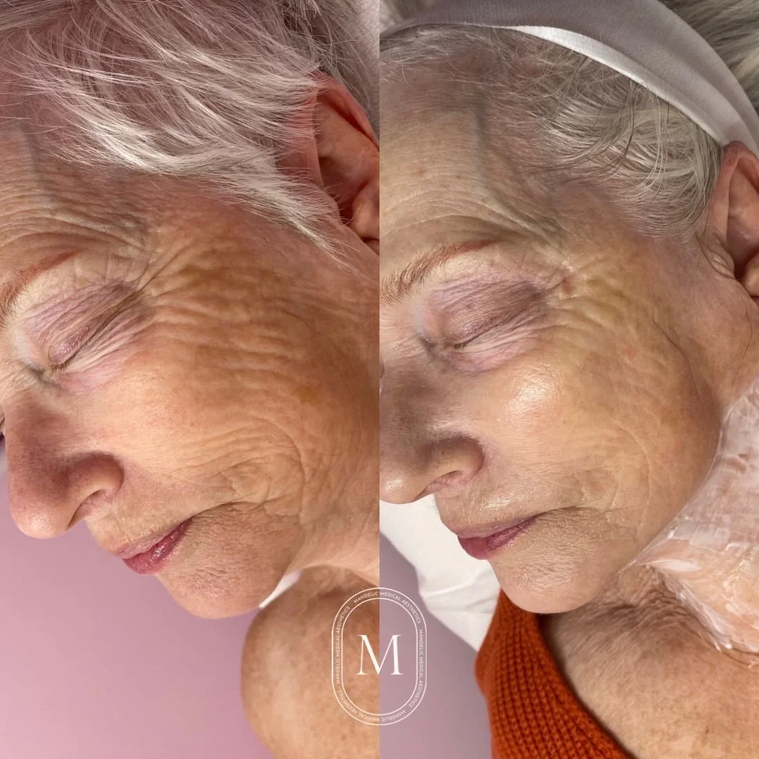 The power of microneedling ✨

If you struggle with &darr;
&bull; pigmentation 
&bull; acne scars
&bull; fine lines &amp; wrinkles
&bull; loss of elasticity
&bull; textured skin
&bull; large pores 
&bull; uneven skin tone 

&hellip;then microneedling 