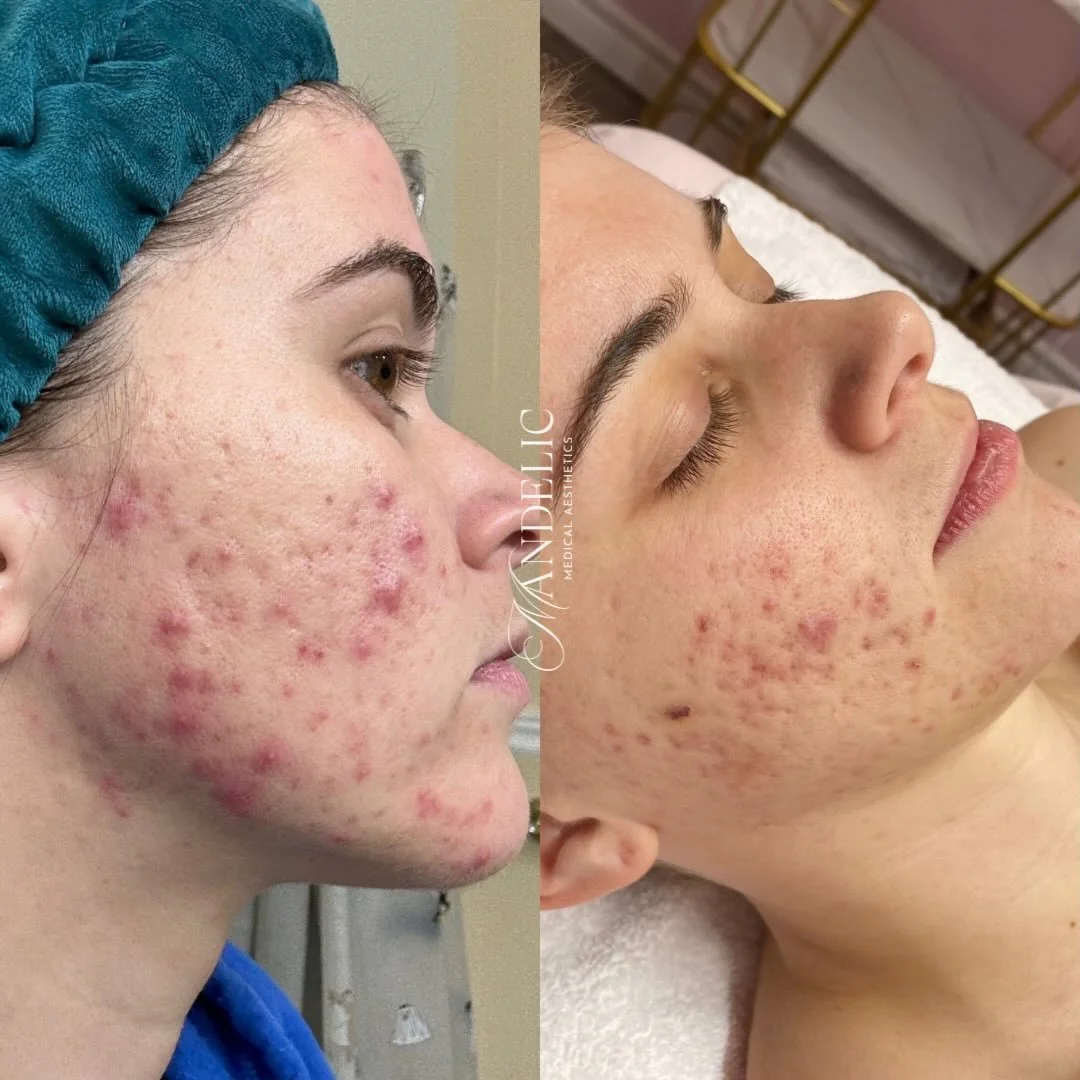 Progress with JUST skincare 👏🏼👏🏼👏🏼

The difference a custom routine can make with the RIGHT products used / layered correctly - amazing! 

Skincare : 

&bull; Idyllic Cleanser by @glymedpluscanada 

&bull; Hale Derma Hypochlorous Acid Spray @ha
