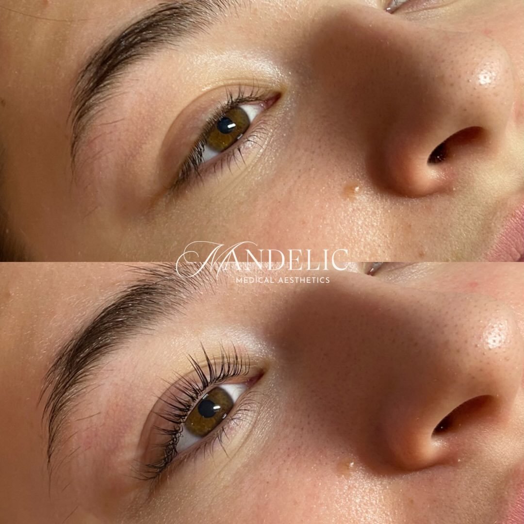 That &ldquo;I woke up like this&rdquo; energy&hellip; but better. Lifted. Tinted. Defined.

45 minutes in the chair = weeks of effortless lashes.

#mandelicmedicalaesthetics #lashtransformation #beforeandafterlashes #lashliftandtint #norfolkcountyspa