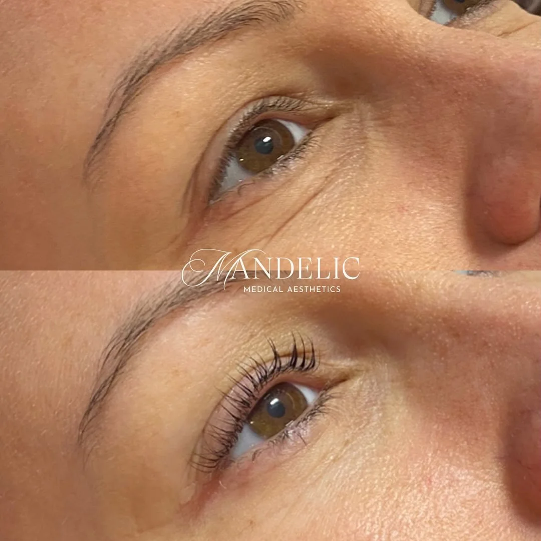 Another lash transformation 🫶🏼

#mandelicmedicalaesthetics #lashes #lashlift #beforeandafter #norfolkcountylashes