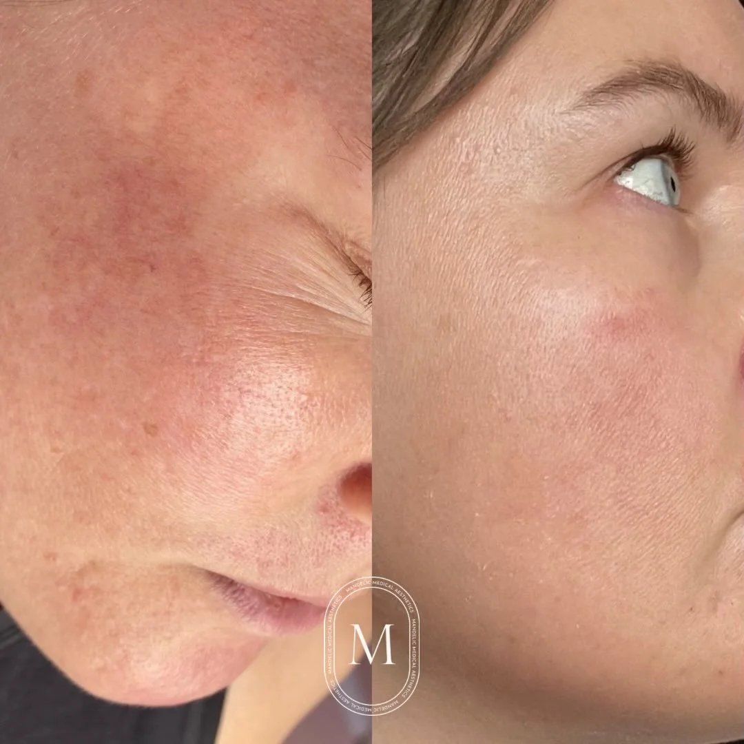Before &amp; after just one Zena Algae Peel ✨

Powered by organic algae + silicon, this treatment targets acne, scarring, pigmentation, melasma &amp; more &mdash; all while keeping your skin barrier happy and your microbiome intact.

Sourced from the
