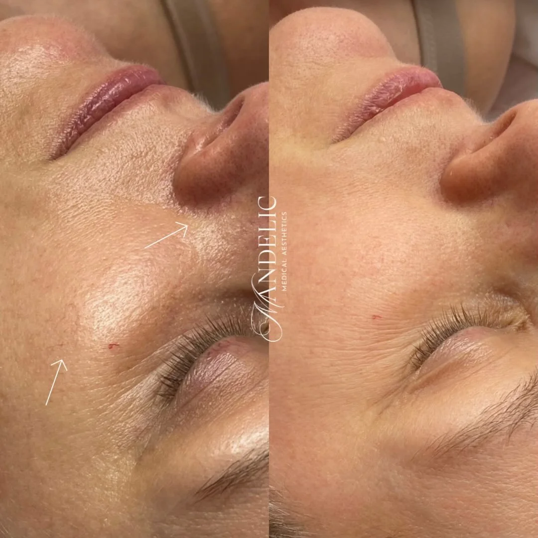 Say goodbye to broken capillaries and hello to a clearer, more even complexion ✨

IPL targets redness at the source, gently fading visible vessels and restoring your skin&rsquo;s natural glow. 

This is your sign to stop covering it up&hellip; and st