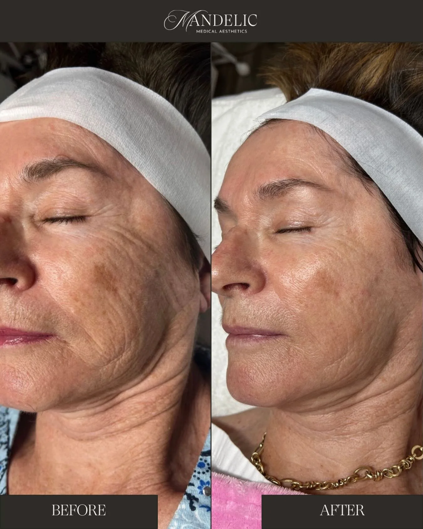 Aging gracefully, glowing intentionally ✨

Softened fine lines, brighter skin, and a refreshed complexion &mdash; all while keeping her natural beauty intact.

Healthy skin will always be the best investment 🤍

𝘵𝘩𝘪𝘴 𝘤𝘭𝘪𝘦𝘯𝘵 𝘳𝘦𝘤𝘦𝘪𝘷𝘦𝘥