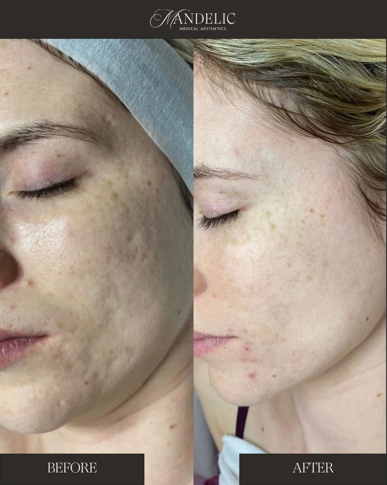 Struggling with :
&bull; acne scarring
&bull; pigmentation + uneven skin tone
&bull; rough texture + enlarged pores
&bull; loss of firmness + elasticity

Two of our favourite treatments for targeting these concerns? Microneedling + the Zena Algae Pee