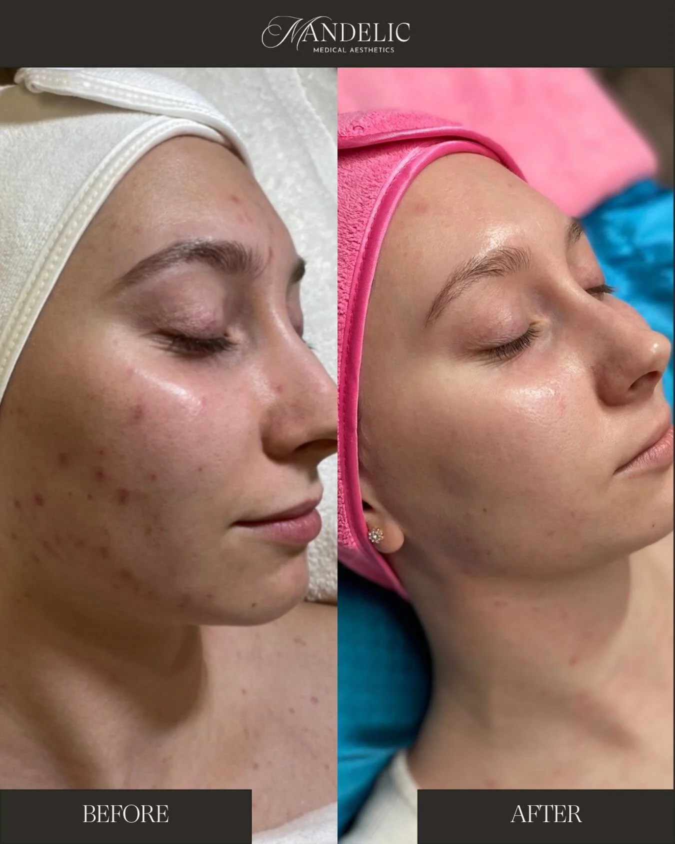 When clients stay consistent with both their skincare routine and professional treatments, the results speak for themselves ✨

This client was started on a customized morning and evening skincare regimen and completed a series of Pumpkin Peels paired