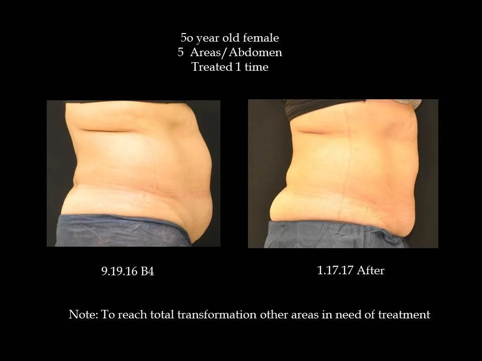 Coolsculpting Body Sculpting Near Me Bel Air MD Harford County