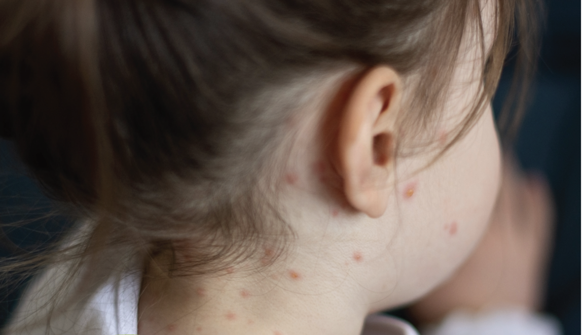Measles: Contagious But Preventable