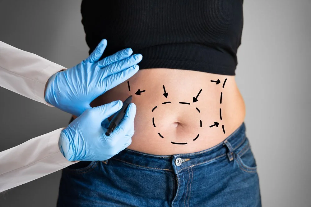 What Areas of the Body Can Be Treated with Liposuction?