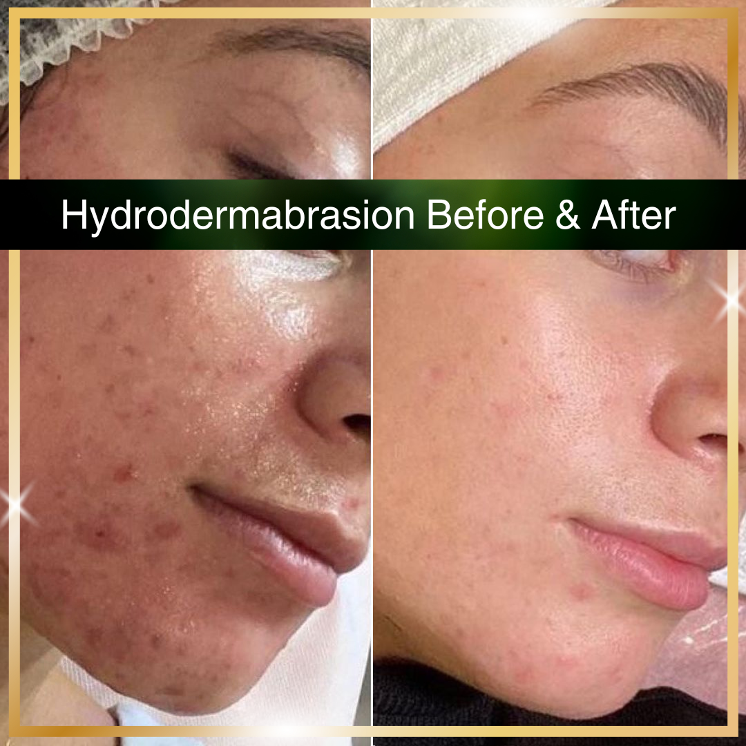 Diamond Hydrodermabrasion — Thrive MedSpa & Wellness