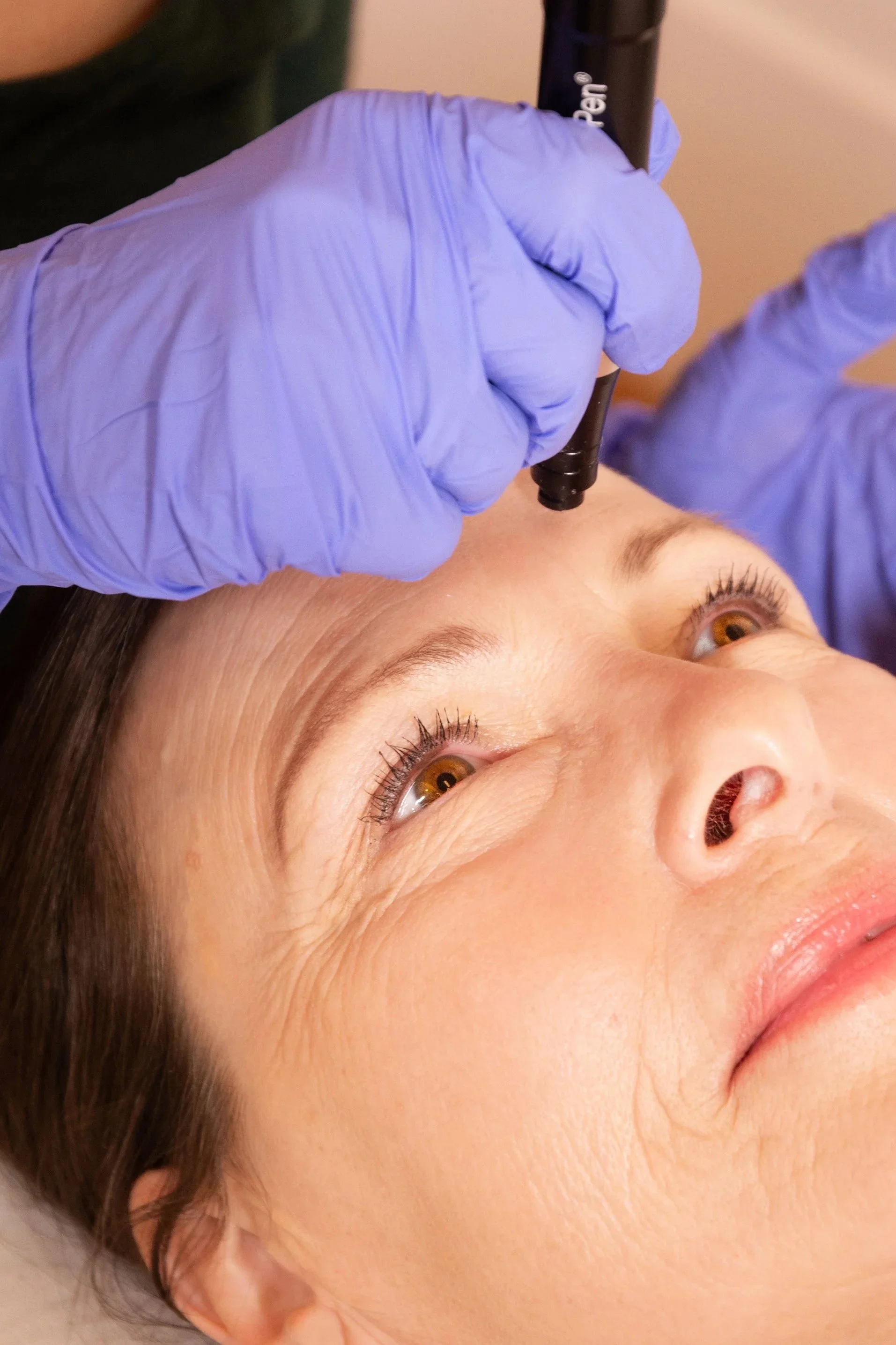 Microneedling, Exosomes, Stem Cells