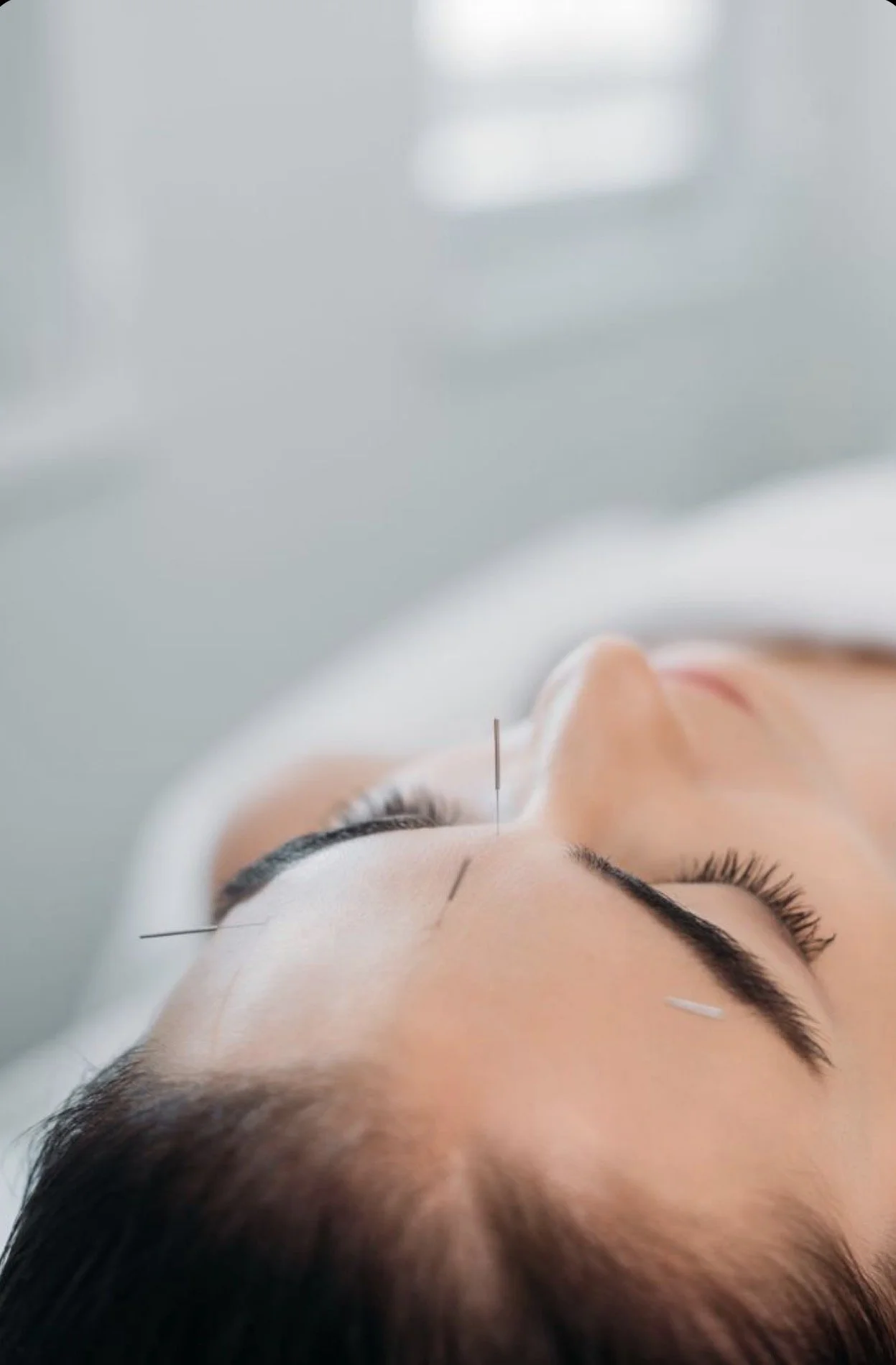 BOTOX VS. FACIAL ACUPUNCTURE
