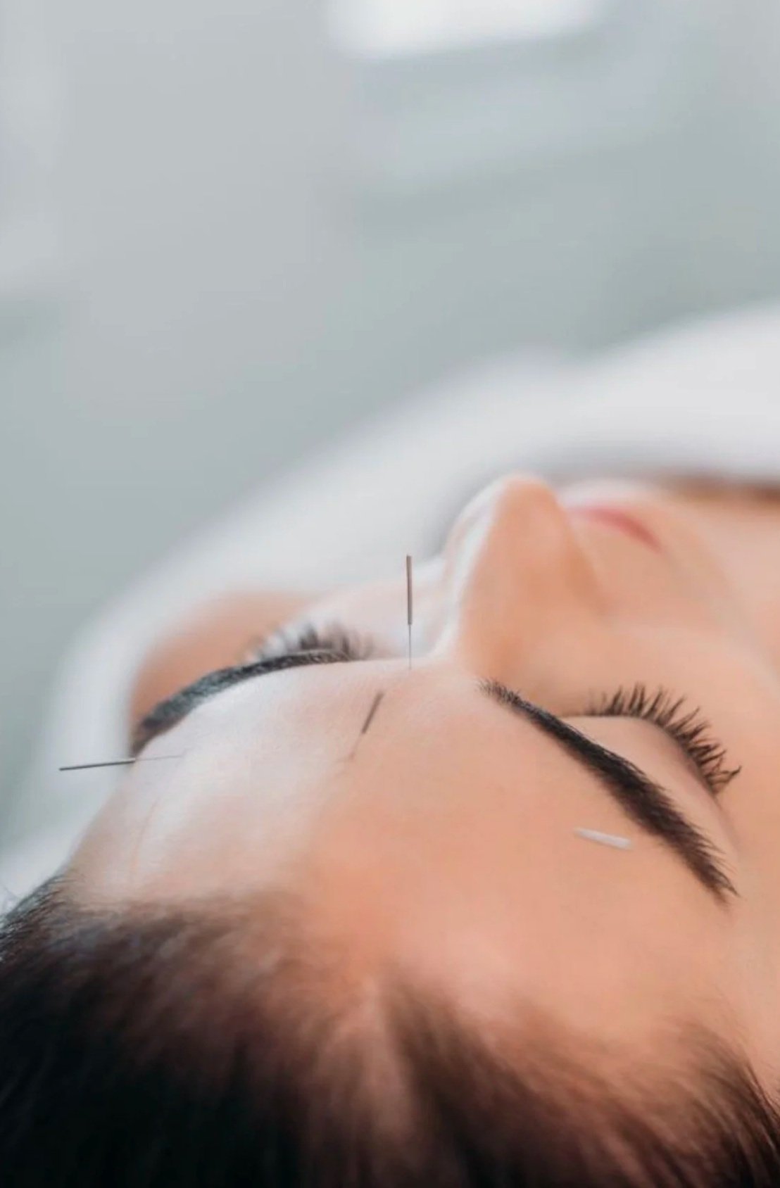 Facial Acupuncture