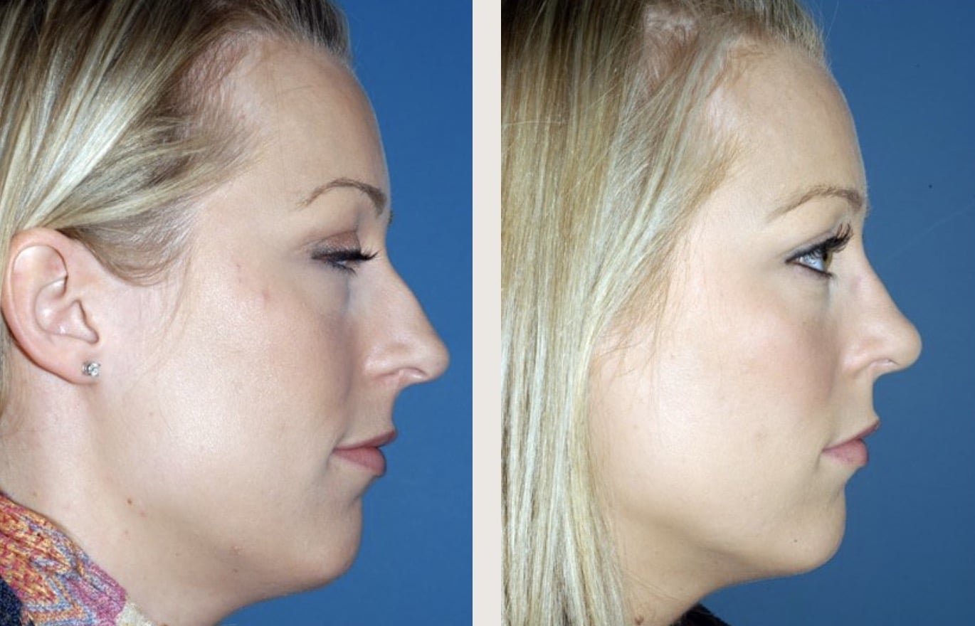 Rhinoplasty Before & After — Vos by Kienstra - Springfield MO Botox Plastic Surgery & More2024.jpg