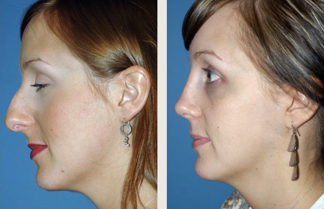 Rhinoplasty Before & After — Vos by Kienstra - Springfield MO Botox Plastic Surgery & More2024 3.jpg