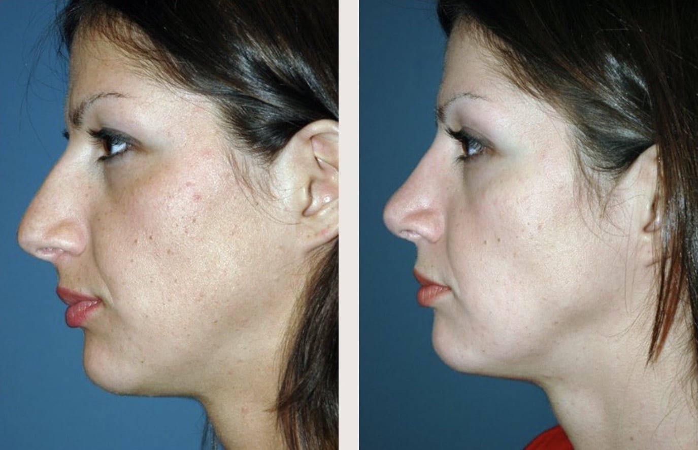 Rhinoplasty Before & After — Vos by Kienstra - Springfield MO Botox Plastic Surgery & More2024 4.jpg