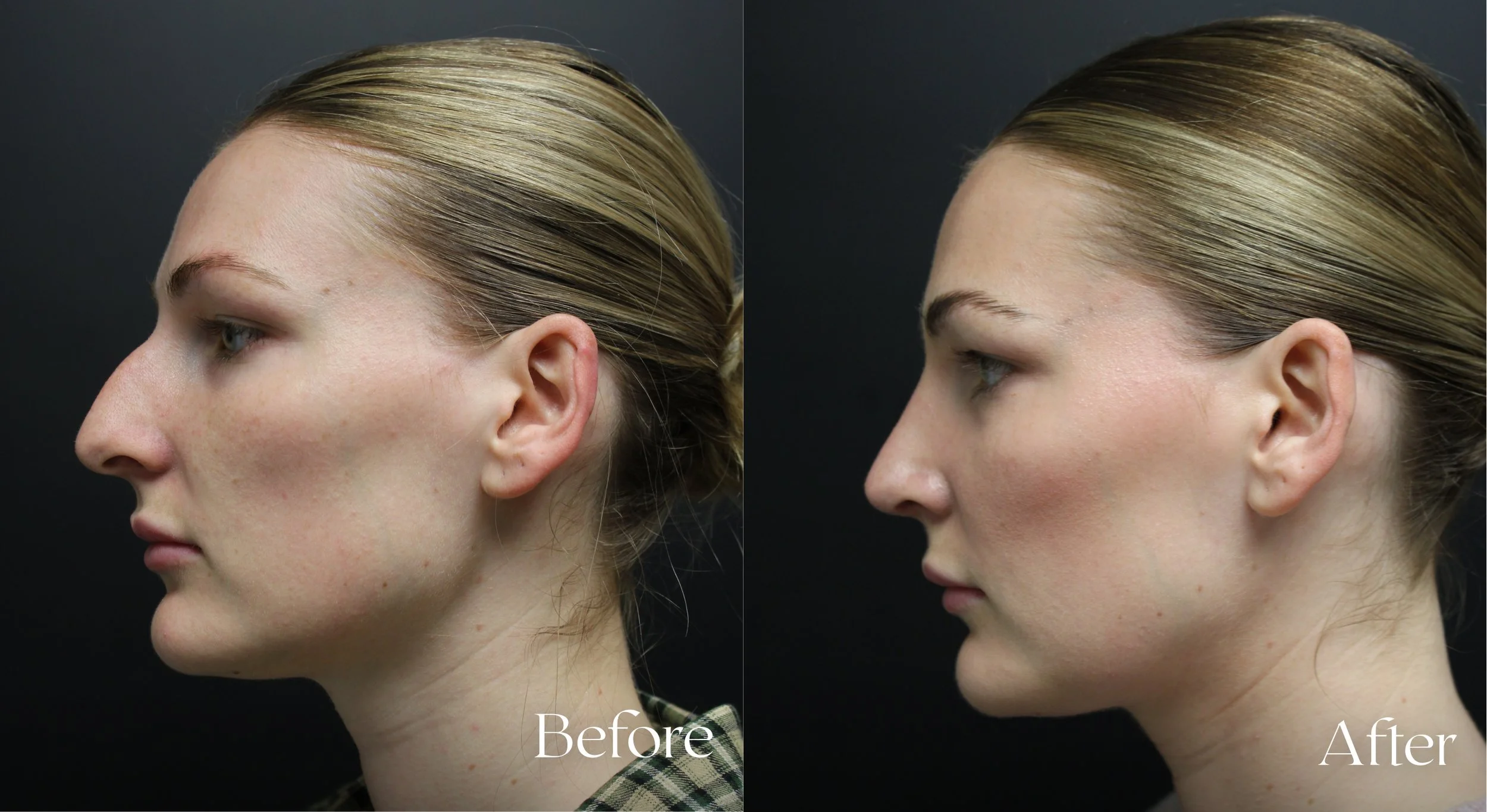 Before and After Side Profile.jpg