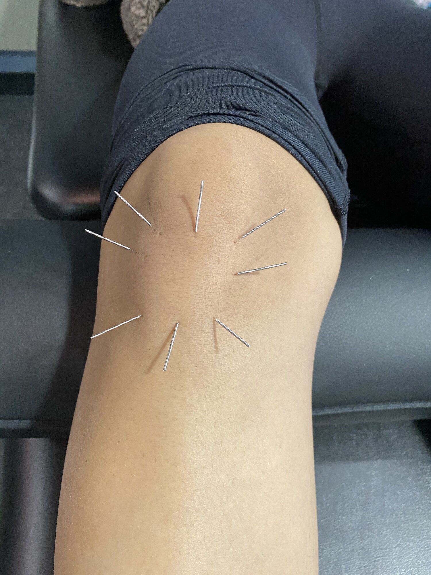 Dryneedling+knee.jpg