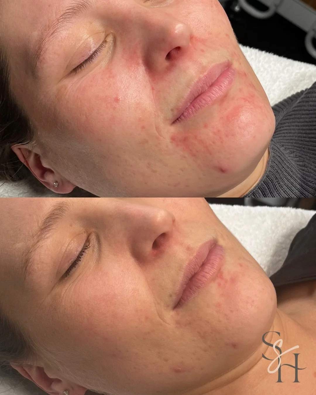 Persistent perioral dermatitis needs more than a topical fix.

When perioral dermatitis keeps coming back, it&rsquo;s rarely just a surface issue.

Skin like this is often responding to deeper inflammation, compromised barrier function, stress, inter