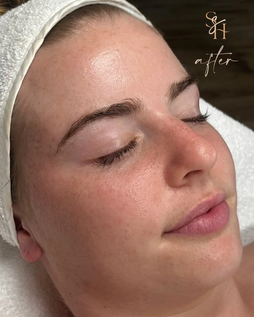 When Shelby first came to see me, she felt frustrated with her congested skin.

Nothing seemed to settle it and she was tired of feeling like she had to cover her skin every day.

We sat down together and talked through her goals in detail. She wante