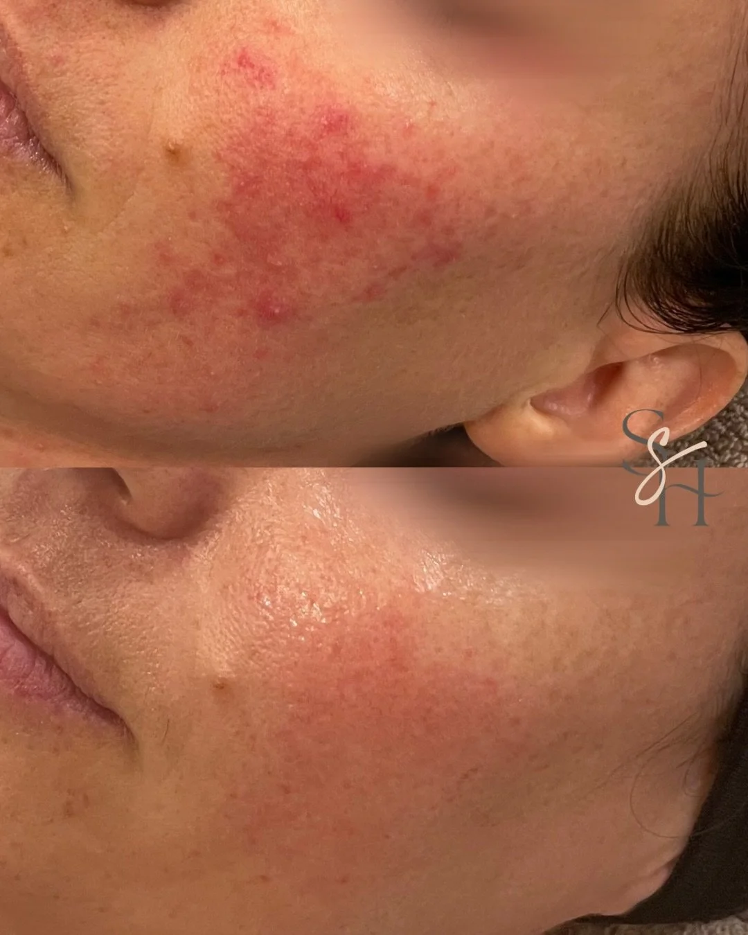 This transformation wasn&rsquo;t about stronger products.

This client didn&rsquo;t need harsher treatments &hellip; she needed her skin to feel safe again.

By calming inflammation, repairing the barrier, and addressing internal triggers, her skin s