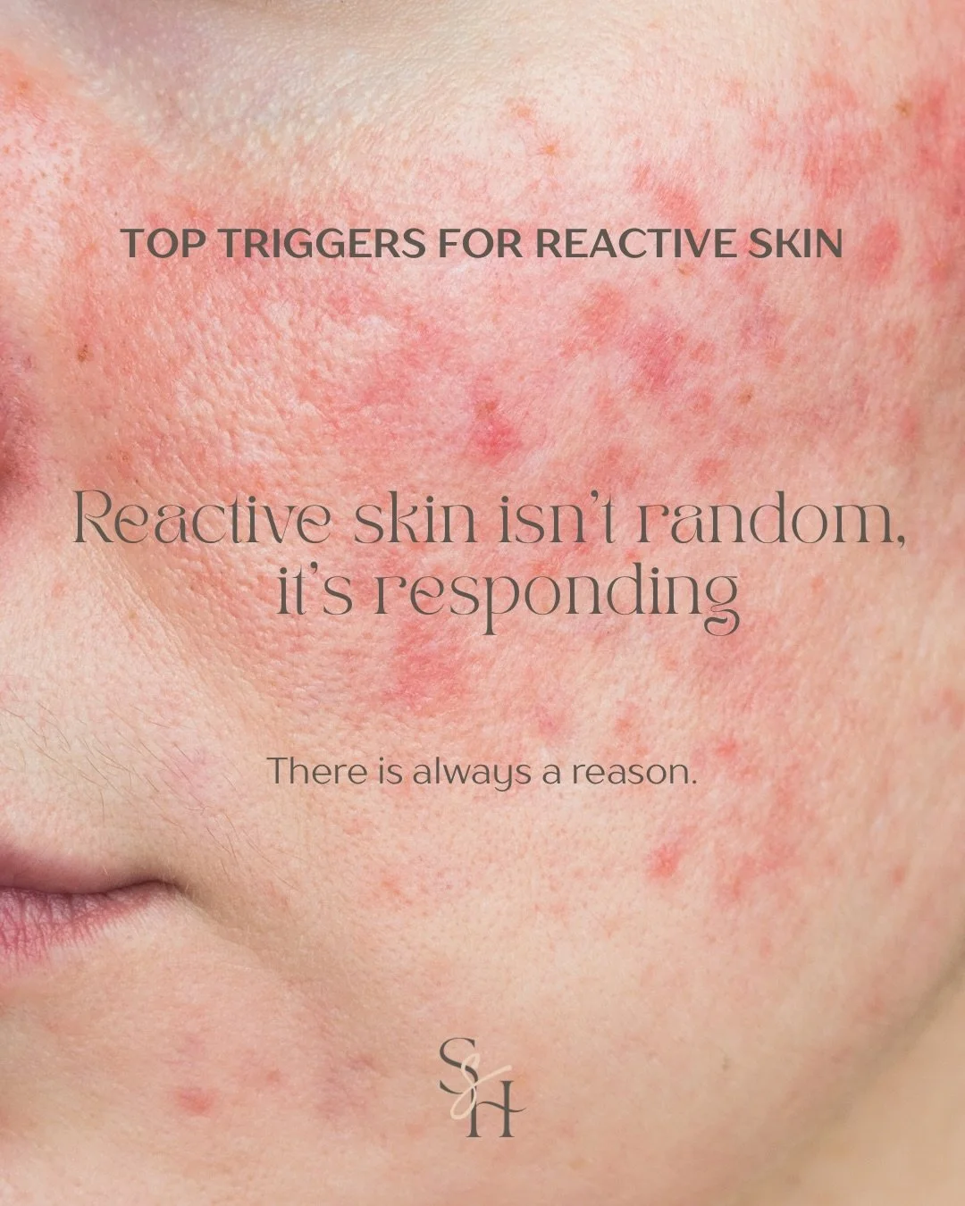 Reactive skin is rarely random.

In clinic, I almost always see a combination of triggers &hellip; not just one.

Common contributors include:
&bull; Over-exfoliation
&bull; Stress and nervous system overload
&bull; Barrier damage
&bull; Too many act