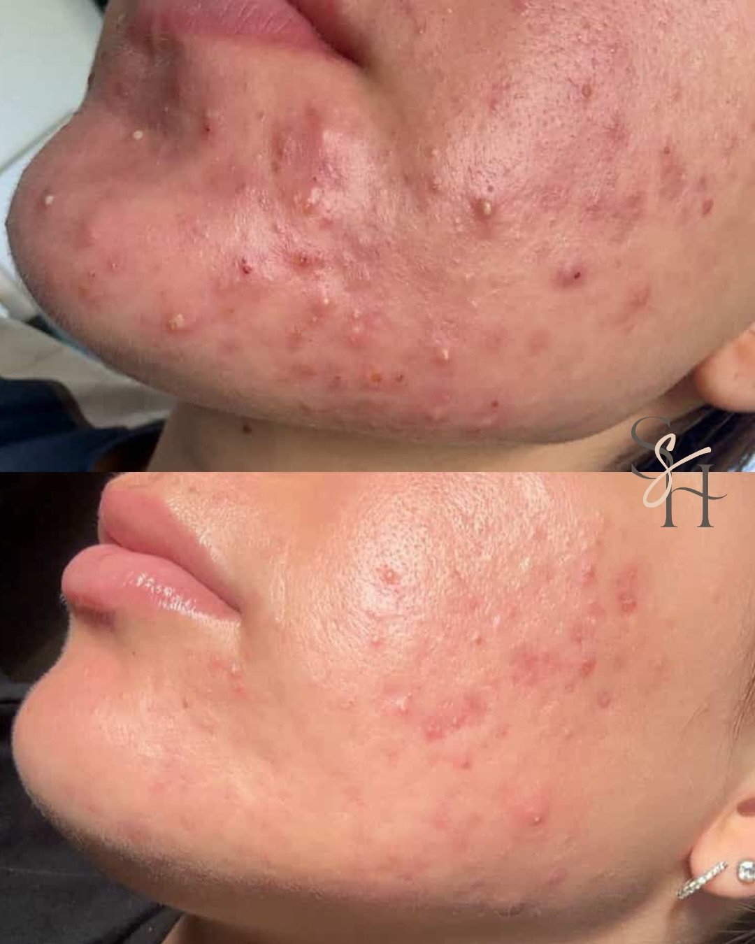 Still breaking out&hellip; even though you&rsquo;re &ldquo;doing everything right&rdquo;?

If you&rsquo;re stuck in the cycle of acne, it can feel exhausting.
You&rsquo;ve tried all the products.
You&rsquo;ve cut out foods.
You&rsquo;ve spent money o