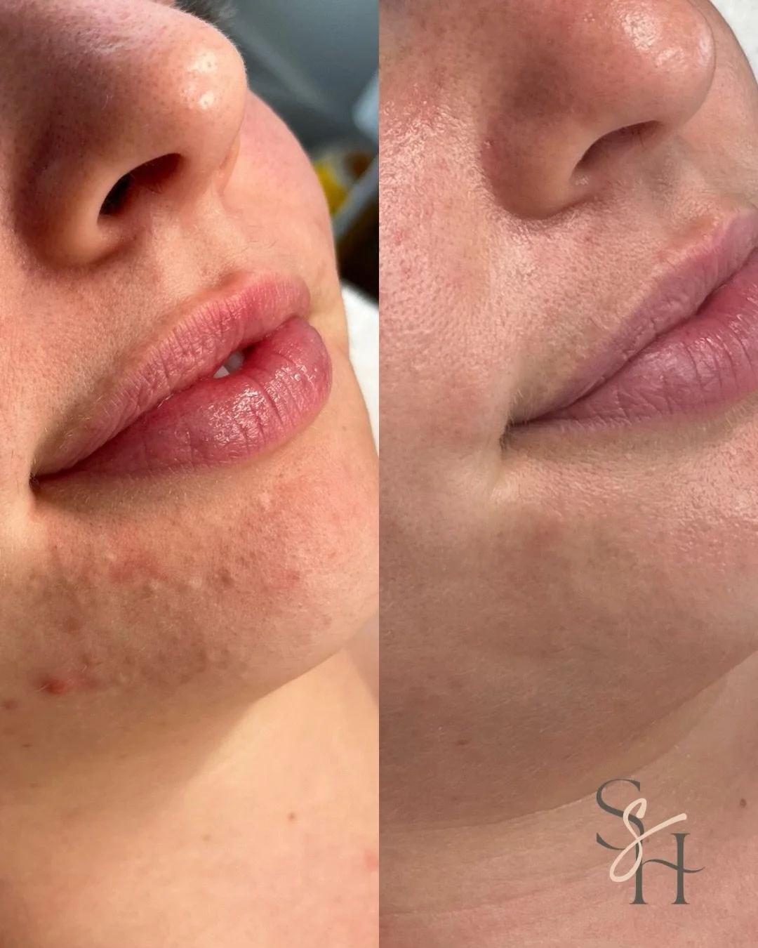 Congested skin isn&rsquo;t just a surface issue. See the real power of gentle, barrier-first care and internal support. 

It&rsquo;s not about stripping or quick fixes. True change comes from understanding your skin&rsquo;s story and supporting it fr