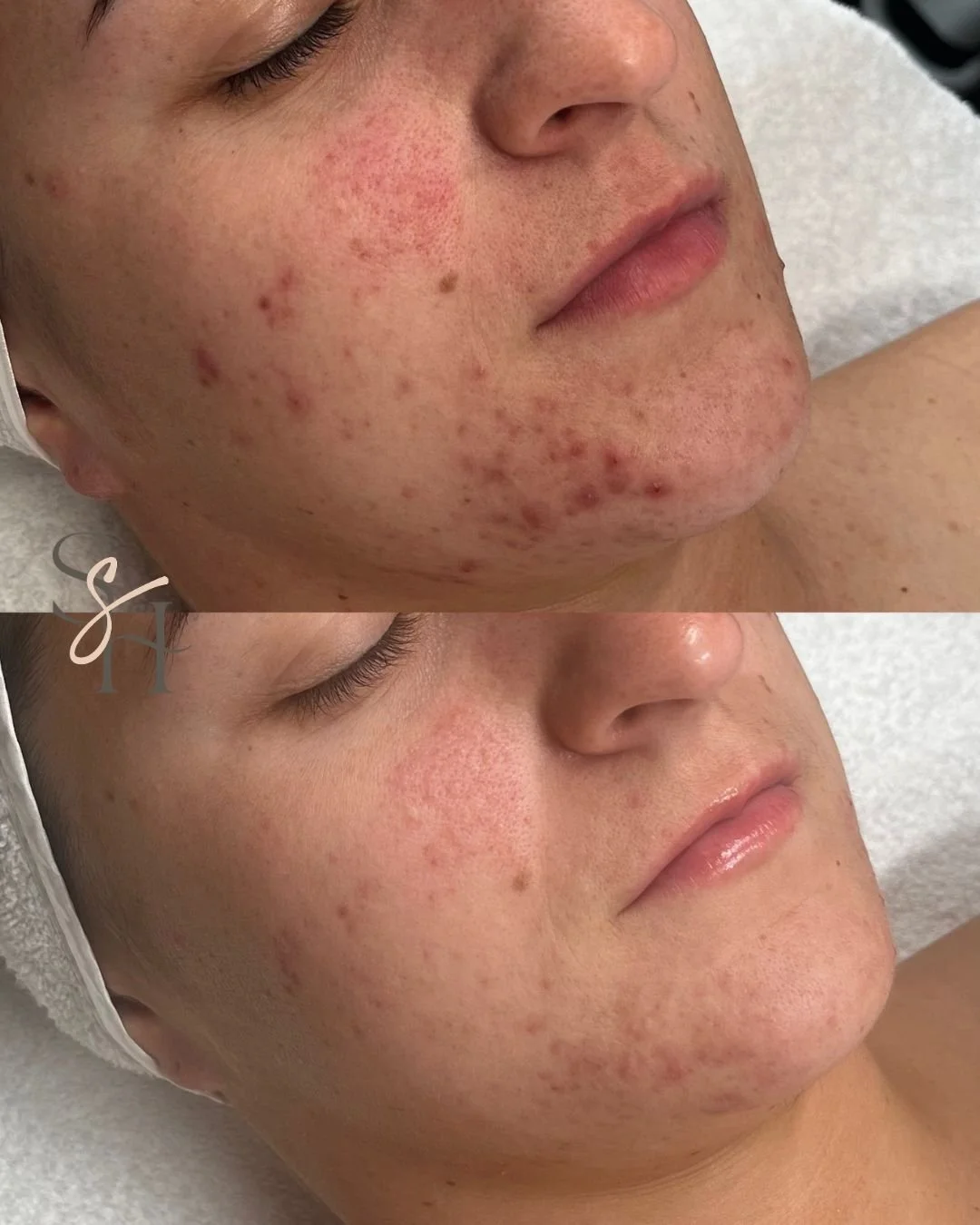 Look what happens when skin feels safe.

This gorgeous client came to me feeling overwhelmed by breakouts and redness. We slowed down, listened, and focused on gentle, barrier-first support. Her skin is calmer, clearer, and so much happier now.

If y