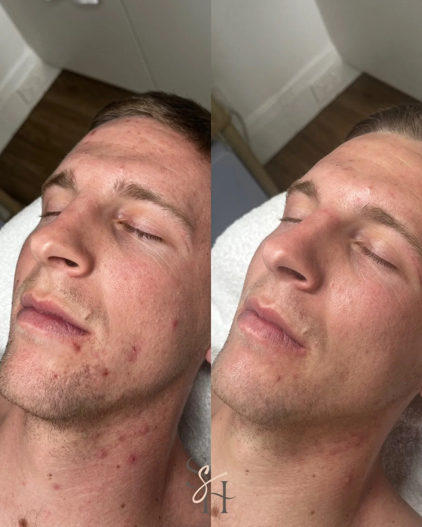 This result speaks for itself 🥇

Acne along the chin, jaw, and neck. A skin that was inflamed, frustrated, and ready for something different.

We slowed down, listened, and worked with his skin, not against it. A few months later, this is where we a