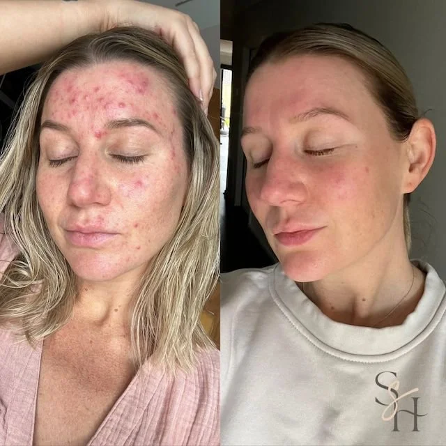 Acne doesn&rsquo;t need to be &lsquo;dried out&rsquo;

I used to think 'the harsher, the better.' But my skin only got angrier. 

Reactive, inflamed skin craves support - not punishment. When you stop stripping and start protecting your barrier, that