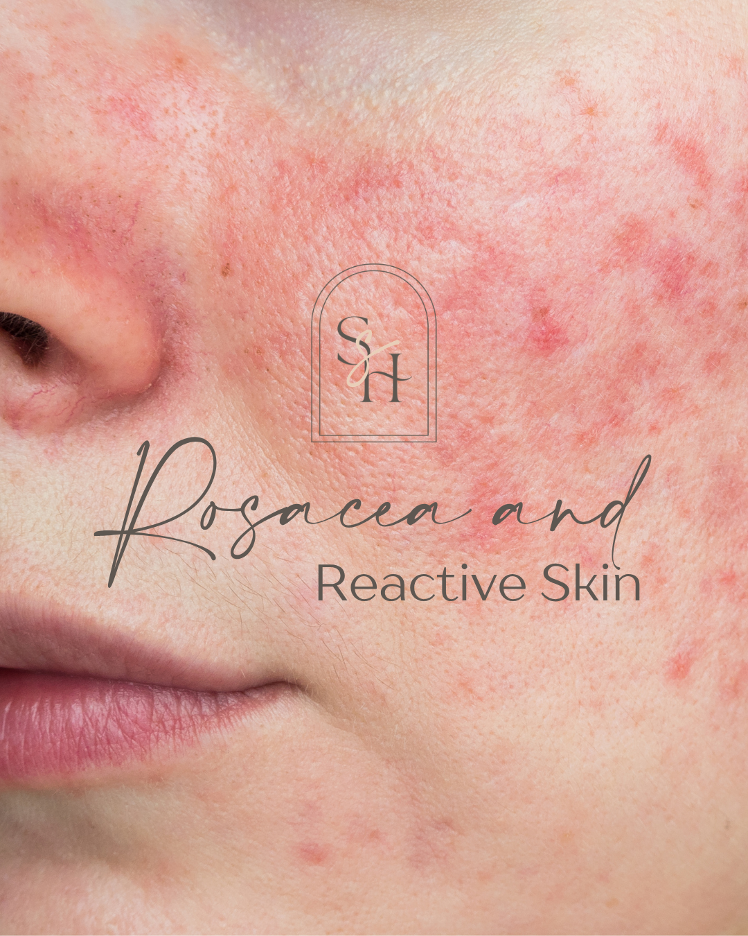 Rosacea and Reactive Skin Basics (What It Is, Why It Happens, and What Helps)