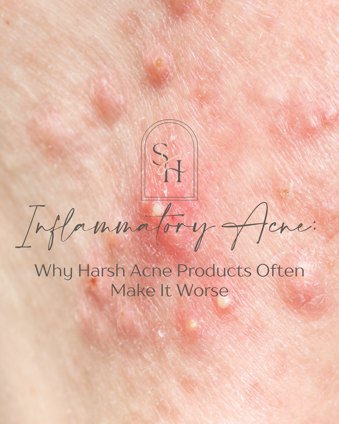 Inflammatory Acne: Why Harsh Acne Products Often Make It Worse