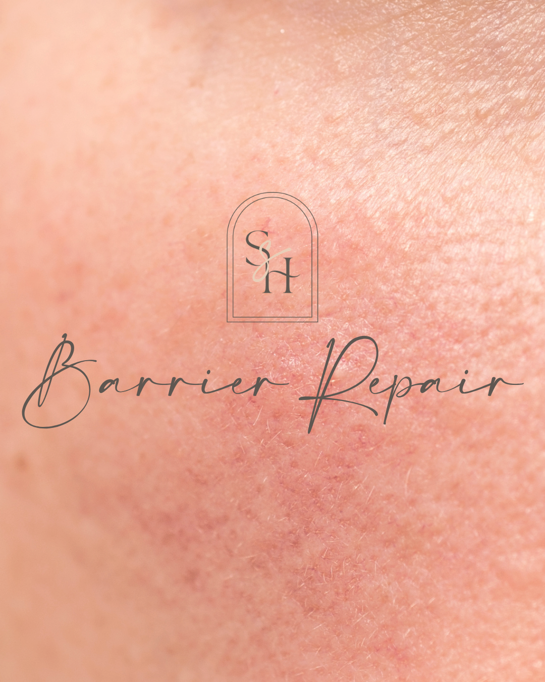 How to Repair a Damaged Skin Barrier (Without Stripping Your Skin)