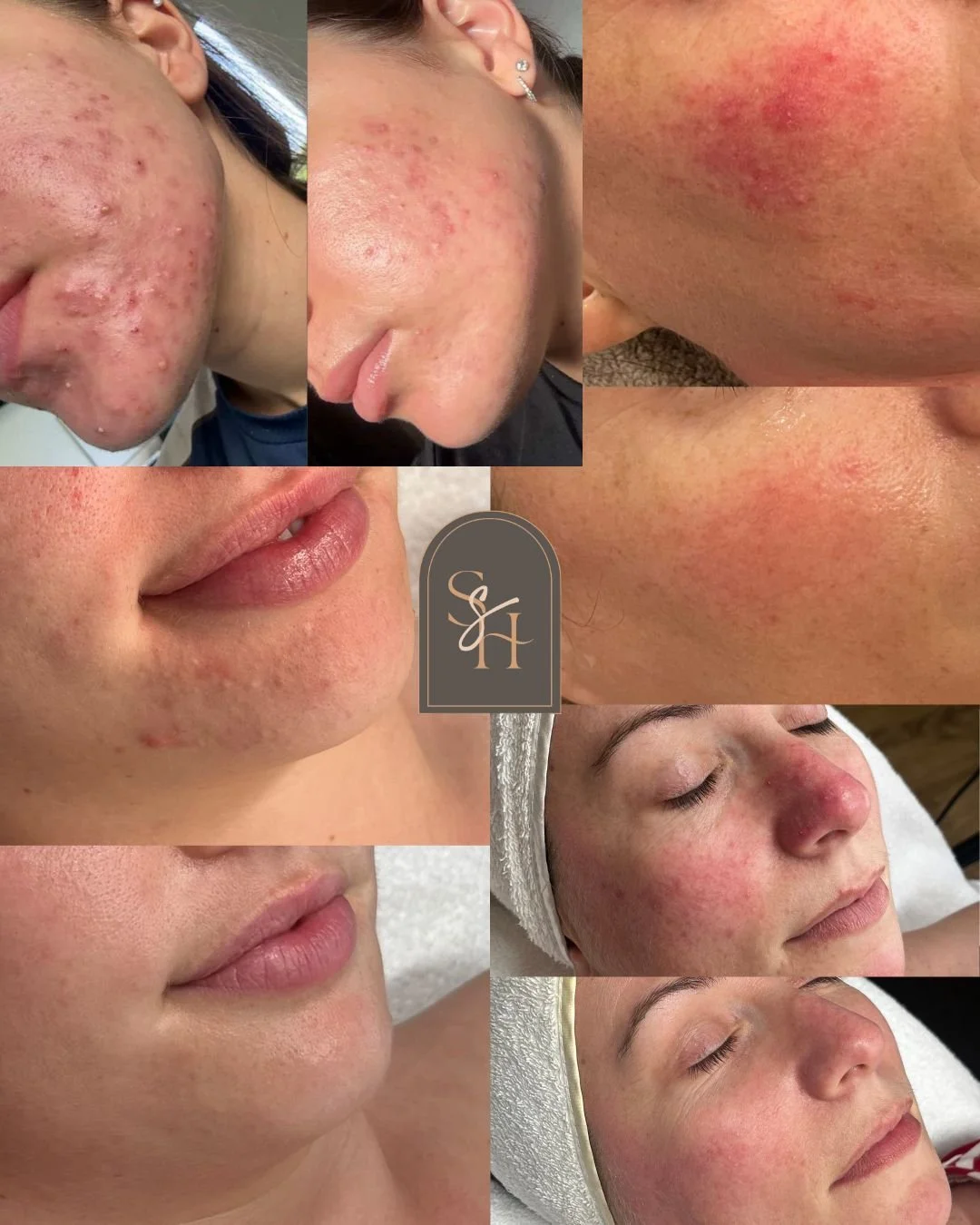 Your skin is not separate from your gut.

What you eat shapes your gut microbiome, and your gut microbiome talks to your skin microbiome.

So when I see inflamed, reactive skin, we often uncover:
&bull; gut inflammation
&bull; dysbiosis
&bull; blood 