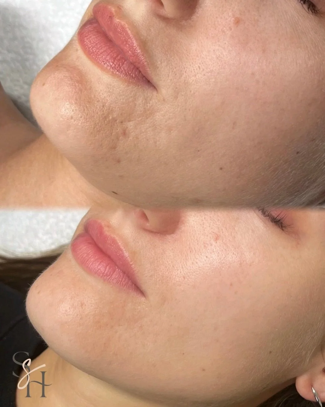 Real results after a series of 3 advanced skin needling treatments ✨

This transformation didn&rsquo;t happen by chance&hellip; it&rsquo;s the result of a targeted, progressive approach combining in-clinic treatments with intentional home care.

Skin