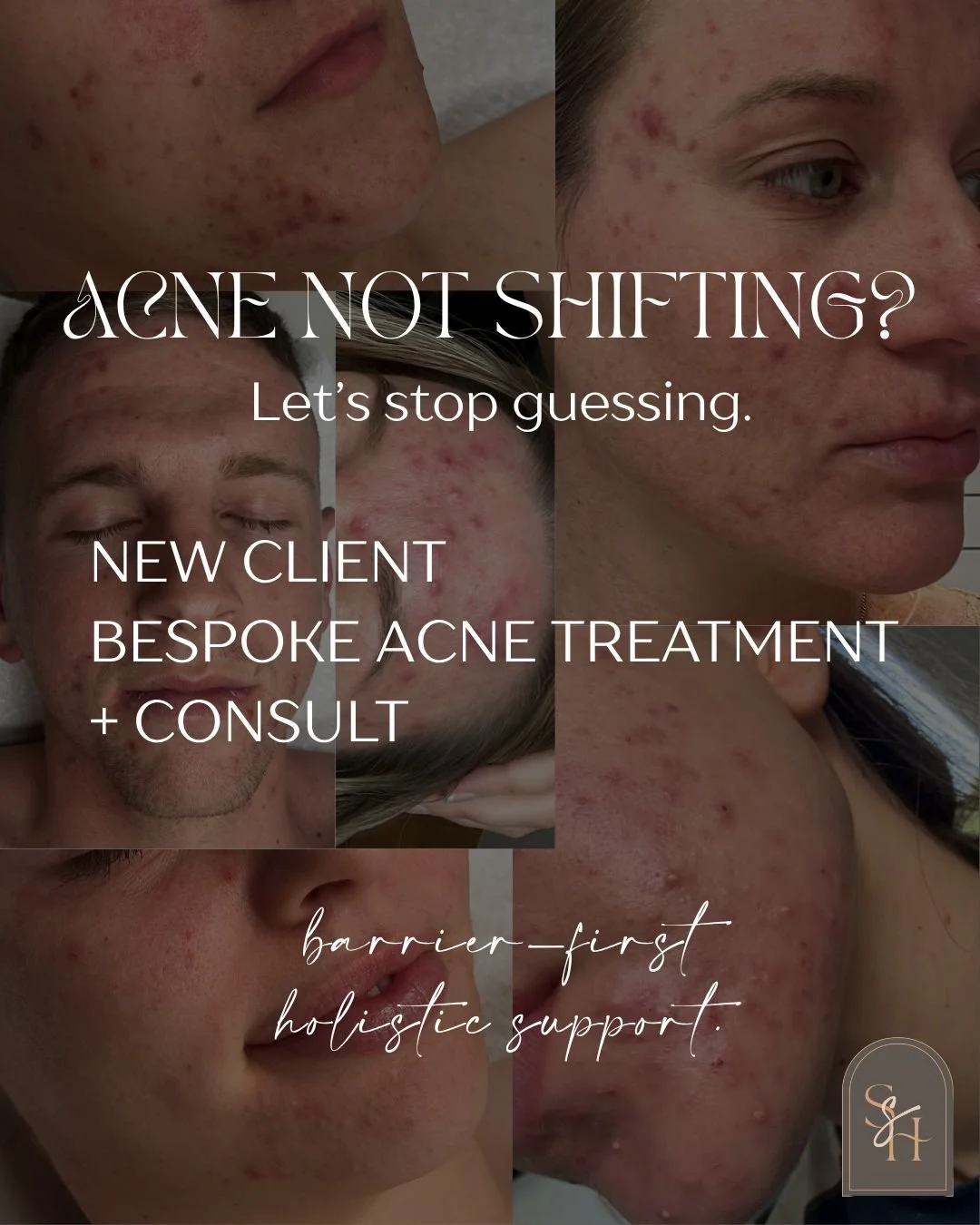 Struggling with acne that feels stubborn, sore, or just never ending?

If you&rsquo;re a NEW client and you&rsquo;re ready for a calm, barrier-first plan (not harsh stripping and guessing), my Bespoke Acne Treatment + Consult Combo is designed for yo