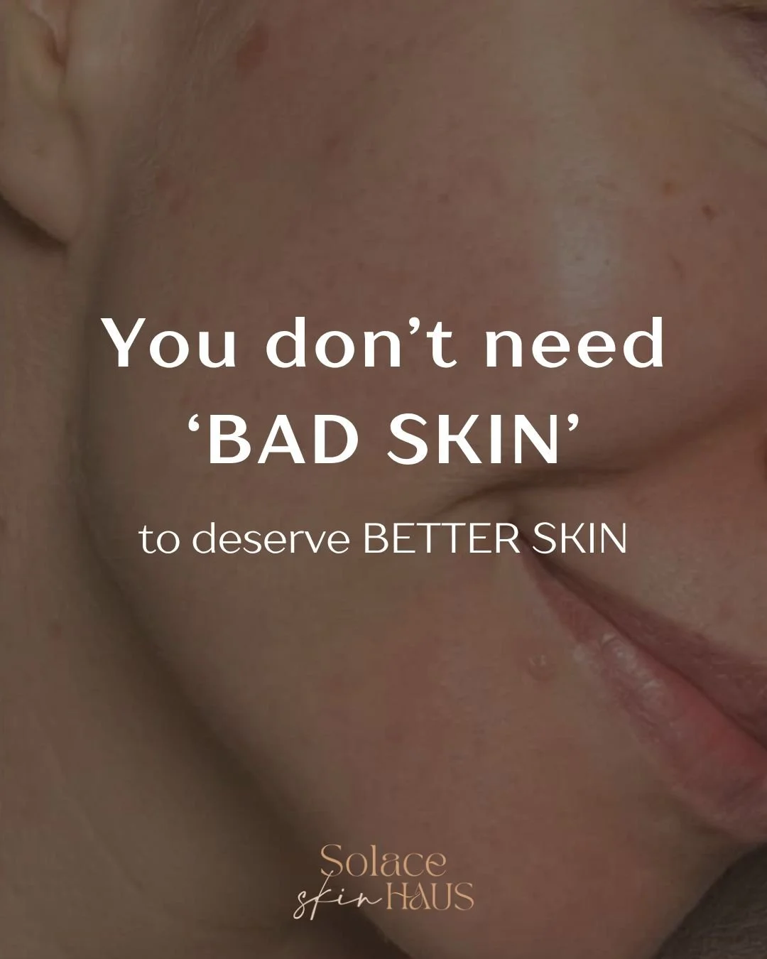Invest in your skin. No acne required.

You don&rsquo;t need a &lsquo;big&rsquo; skin problem to deserve support. 

This client came to me feeling frustrated, not because of severe skin issues, but because she was sick of having to 'cover up'.

She w