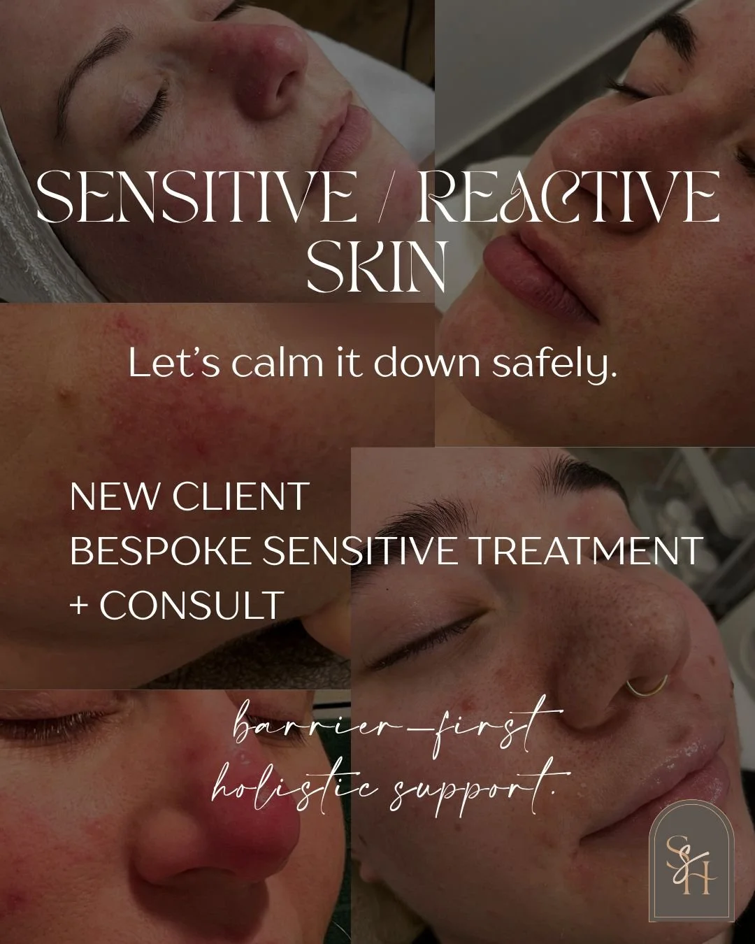Sensitive skin isn&rsquo;t &ldquo;weak&rdquo;. It&rsquo;s usually overworked, inflamed, or running low on barrier support.

If you&rsquo;re a NEW client and your skin flushes easily, stings, feels tight after cleansing, or reacts to &ldquo;everything