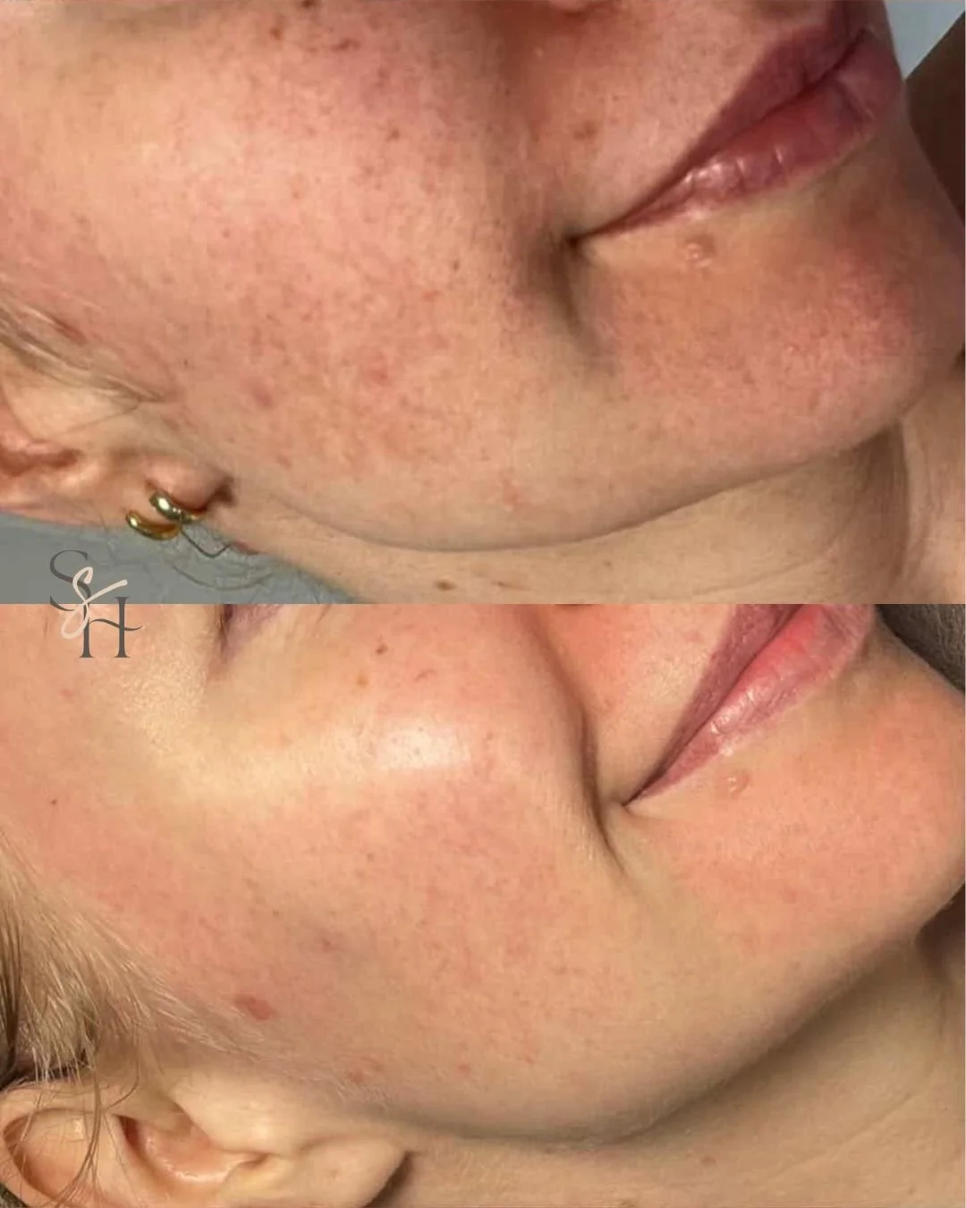 If you&rsquo;ve tried everything and your skin still feels angry&hellip; it&rsquo;s not because you&rsquo;re doing it &ldquo;wrong&rdquo;.

Most of the time, it&rsquo;s because your barrier is overwhelmed.

My approach is always:
CALM first&hellip; t