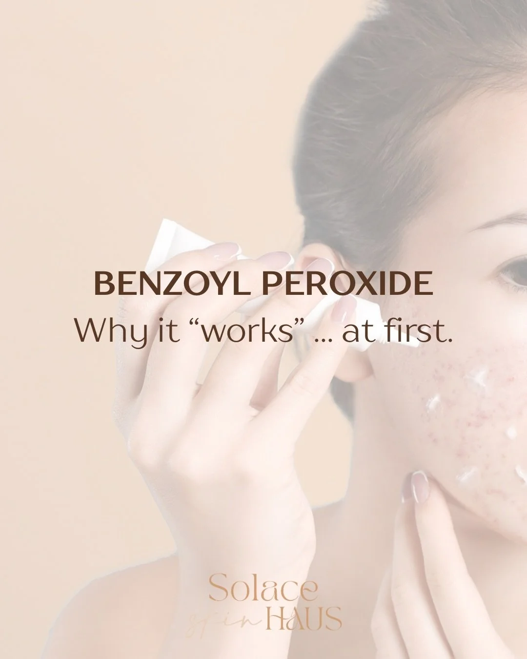 Benzoyl peroxide can look like it&rsquo;s &ldquo;working&rdquo; at first.

Here&rsquo;s what it&rsquo;s doing:
It penetrates into the pore and introduces oxygen, creating an oxygen-rich environment that&rsquo;s lethal to Cutibacterium acnes (the bact