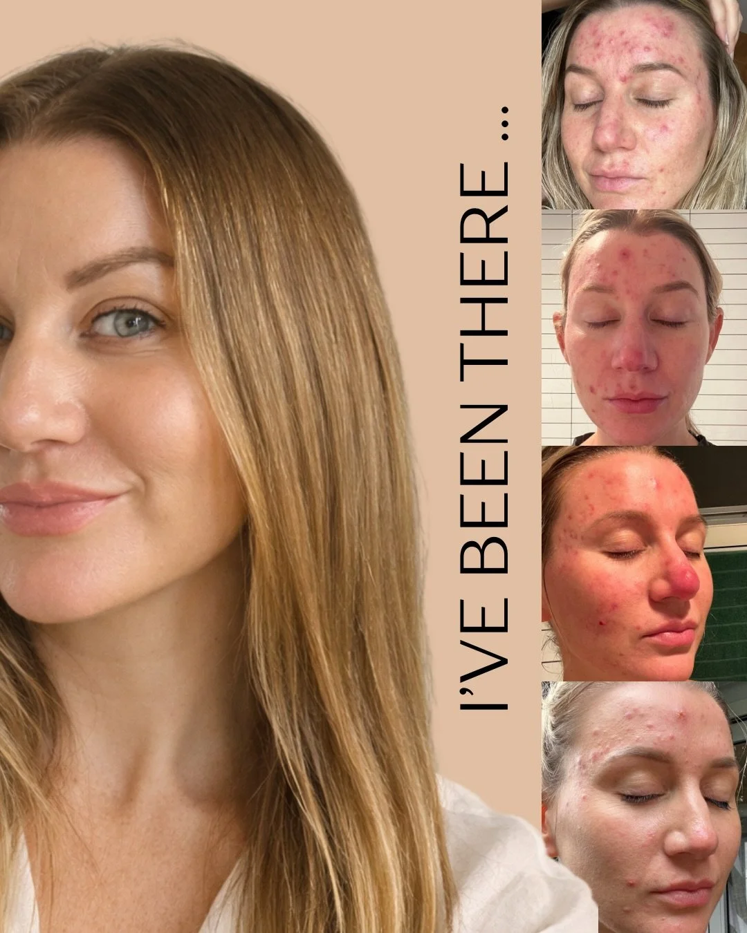 It&rsquo;s Acne Awareness Month, and I want to spend June getting honest about what acne actually is.

It&rsquo;s not a hygiene problem. It&rsquo;s not a sign you&rsquo;re doing something wrong. And it&rsquo;s rarely just a surface issue.

Acne is yo