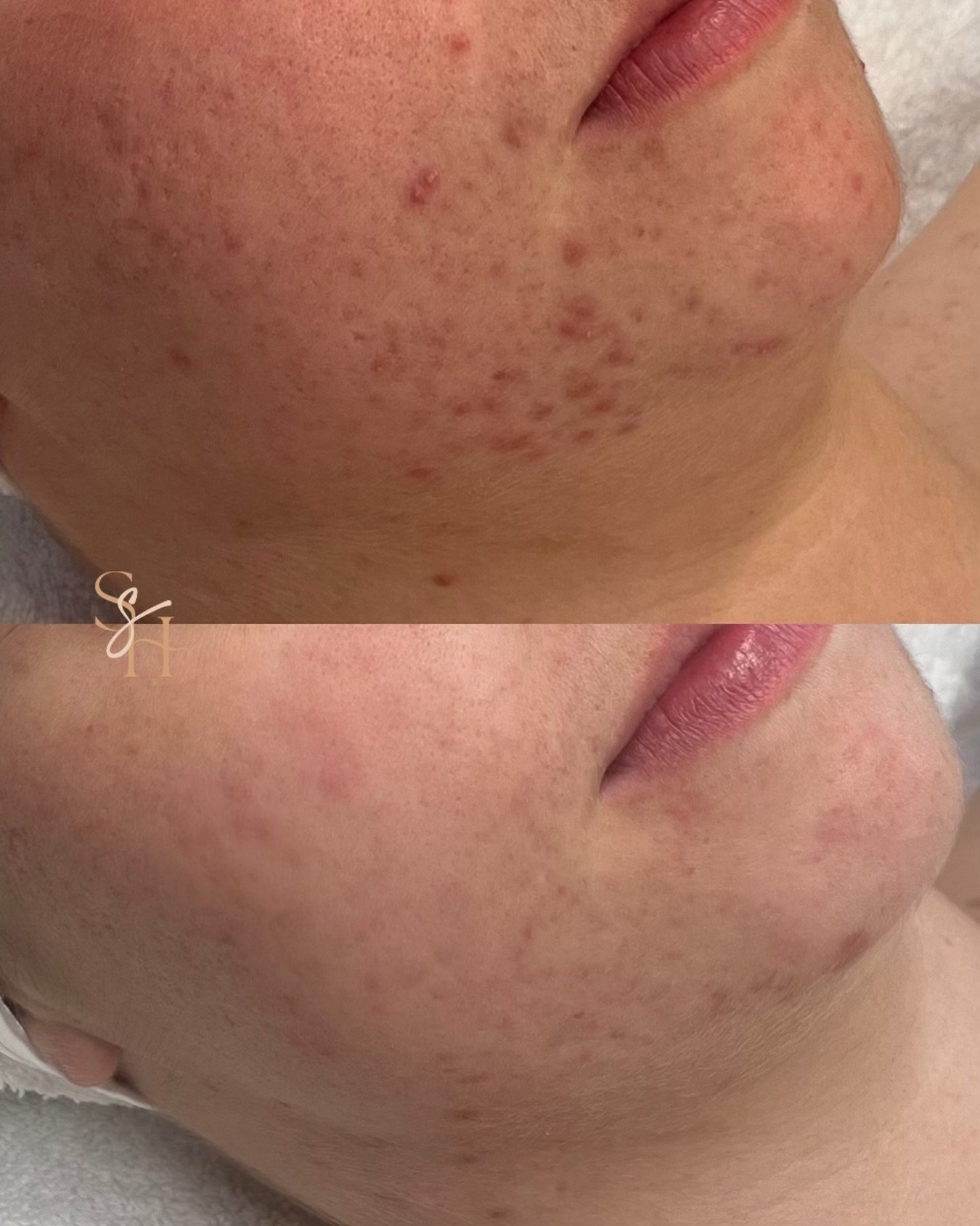 Hormonal acne is one of the most frustrating types to deal with, because it often feels completely out of your control.

It tends to show up along the jawline, chin nad neck. It typically (not always) flares before your period. It gets worse during s