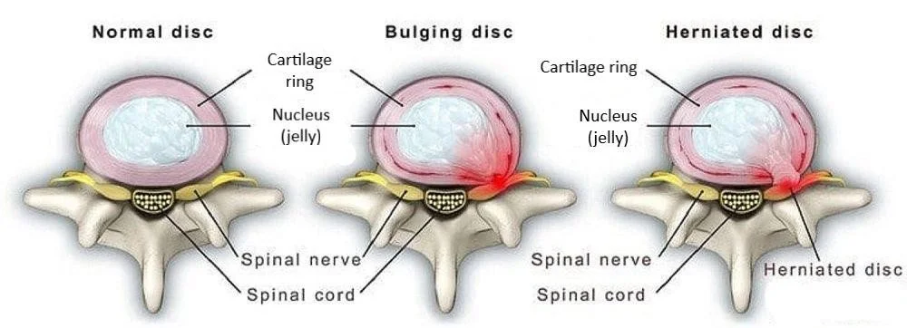 Should I See a Chiropractor for a Bulging or Herniated Disc?