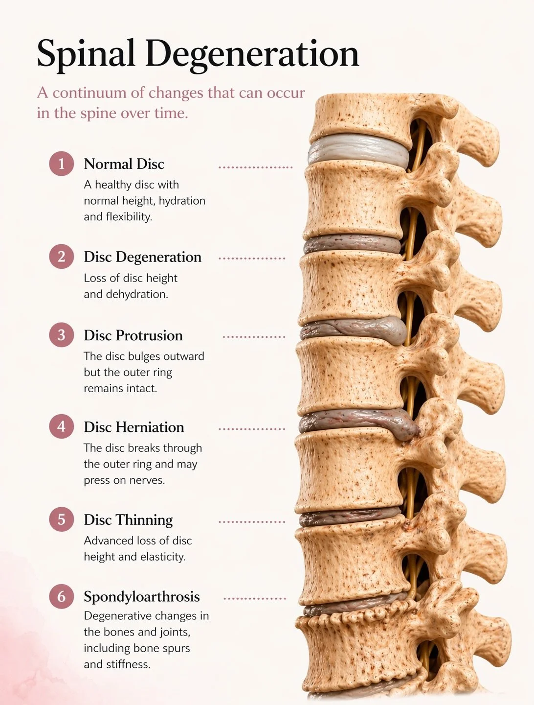 Ever wondered what doctors mean when they talk about disc degeneration, disc bulges or herniated discs?

Spinal discs sit between the vertebrae and act like shock absorbers, helping the spine move while distributing load.

A healthy disc contains a s