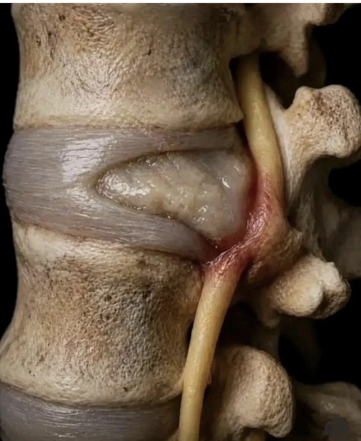 Sciatica: What It Is, Why It Happens, and What You Can Do About It